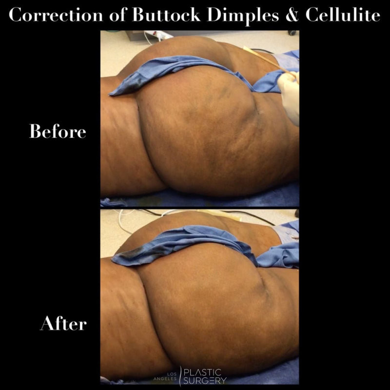Buttock enhancement : Buttock Dr Ballieux, plastic surgery specialist